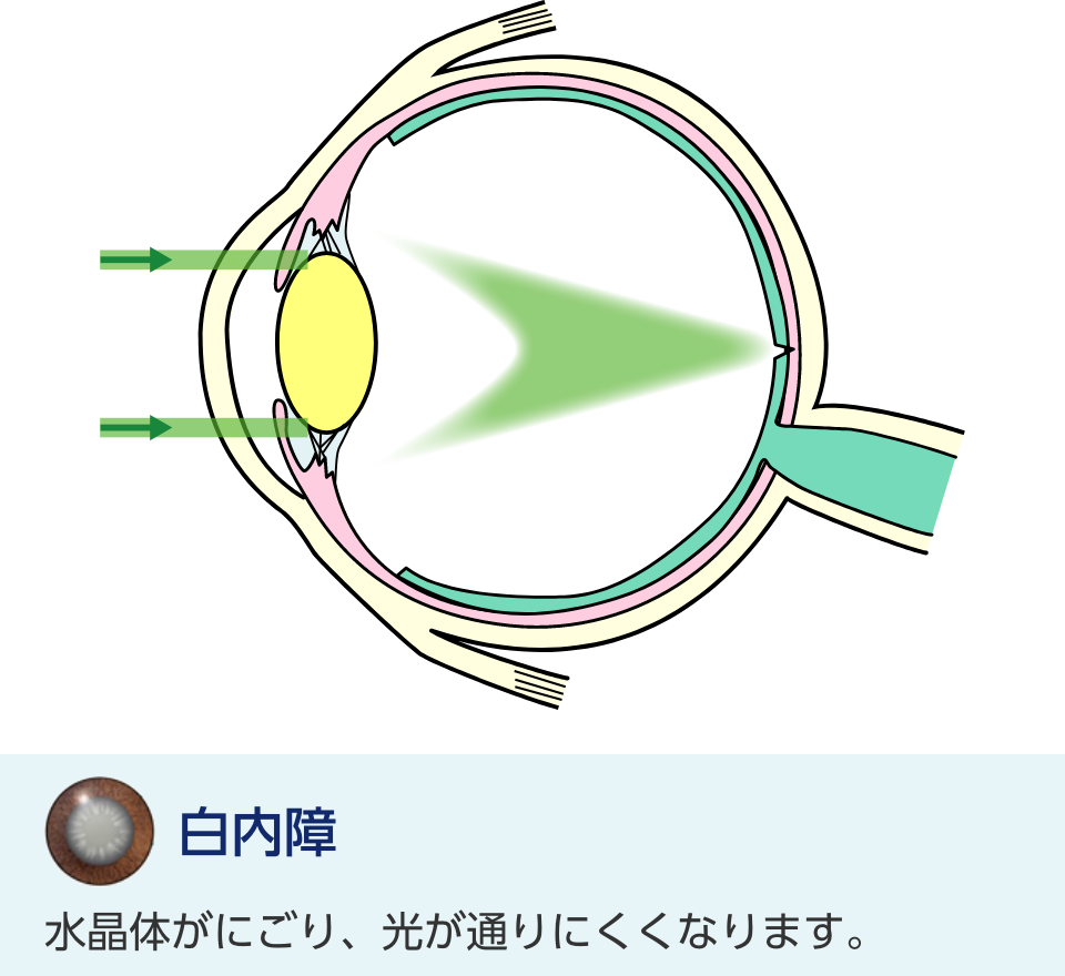 白内障