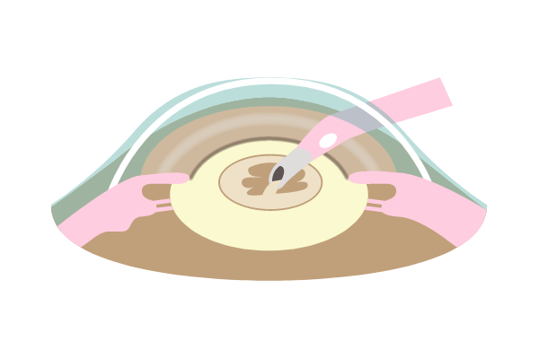 水晶体乳化吸引